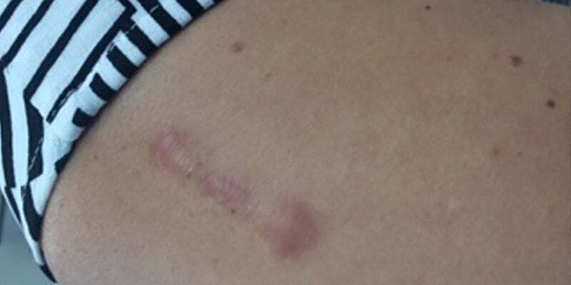 Principles of Wound Healing and Managing Small Procedures in General Practice