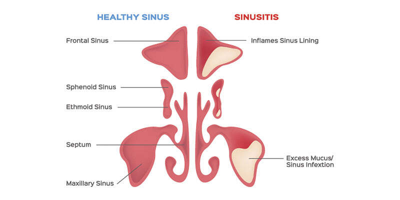 Sinusitis