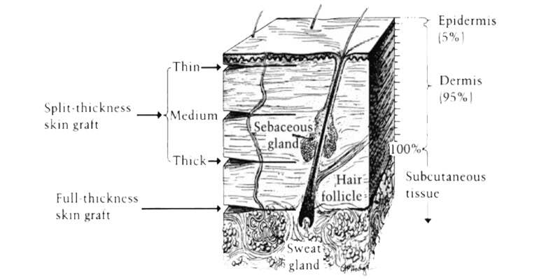 Skin grafting