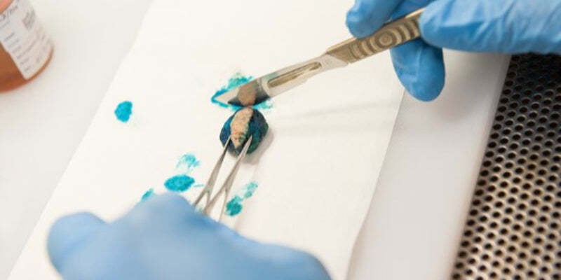 Specimen processing: Does the type of biopsy make a difference? Correlation cases (Nurses)