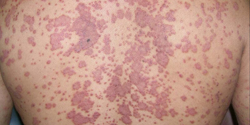 Systemic treatment options for psoriasis and Systemic treatment of Lichen Planus