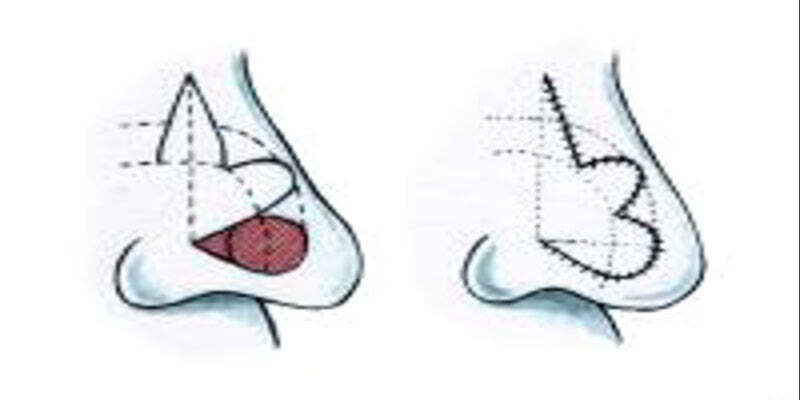 Bilobed flap