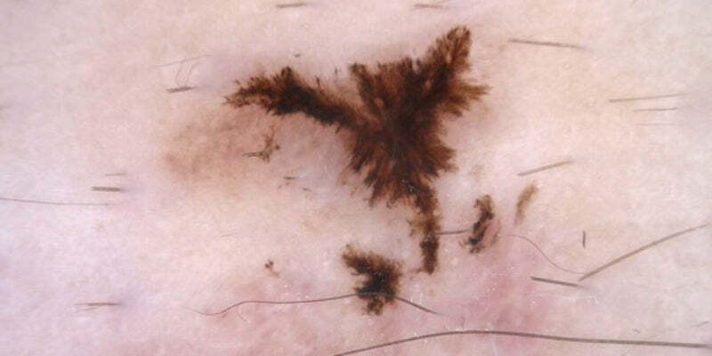 The broad spectrum of BCC and keratinocyte skin cancer (Nurses)