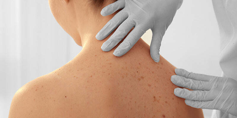 Theory, Anatomy and Principles of Skin Cancer Surgery