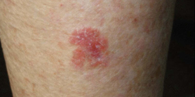 Topical treatment and medico-legal issues for skin cancer medicine
