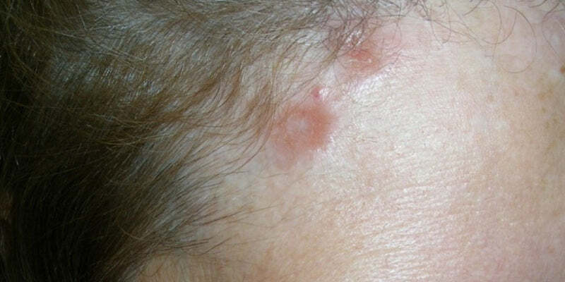 Treatment of dermatomyositis and sarcoidosis
