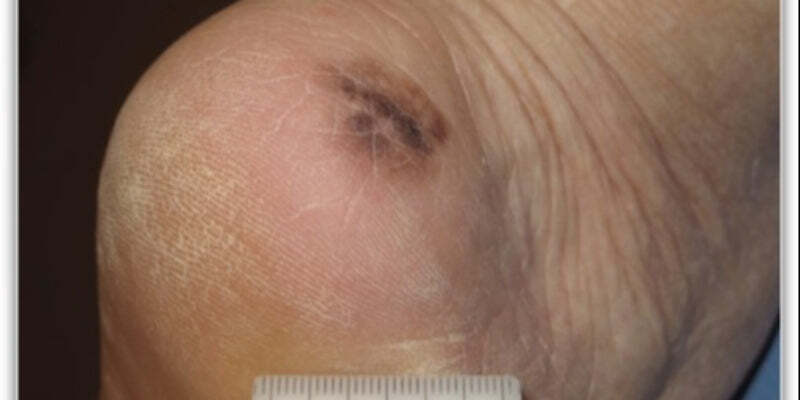 Types of lesions - Flat/nodular, pigmented/non-pigmented