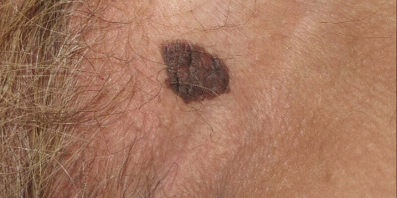 Vulvar skin diseases